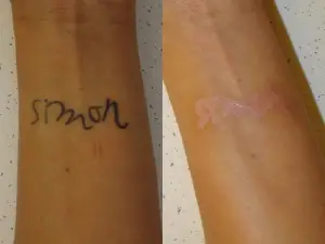 does tattoo removal leave scars