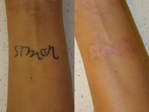 Does Tattoo Removal Leave Scars? How To Prevent And Minimize Tattoo Removal  Scarring - Tattify