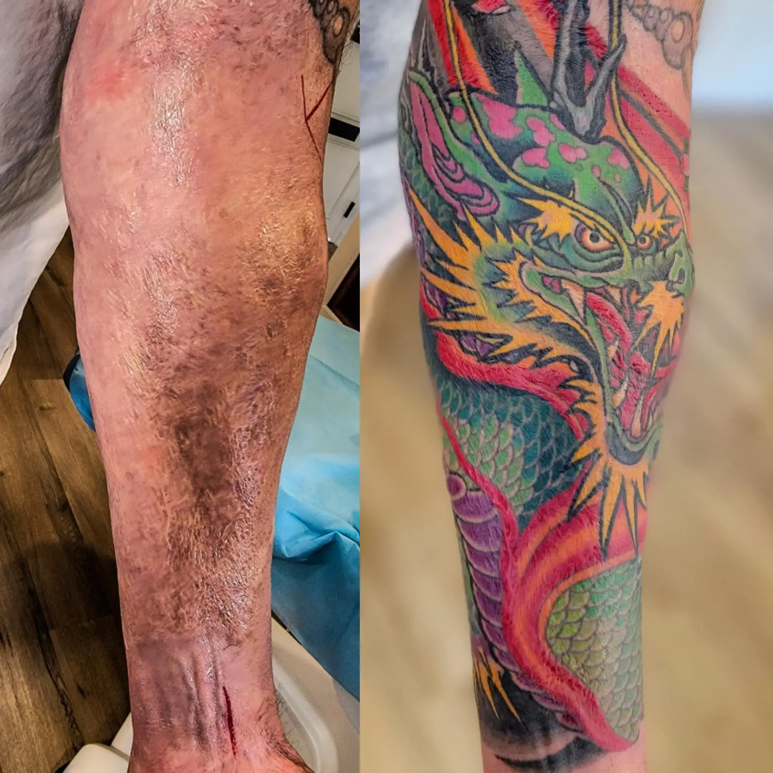 I Have A Burn Scar - Can I Get A Tattoo Over It? - Tattify